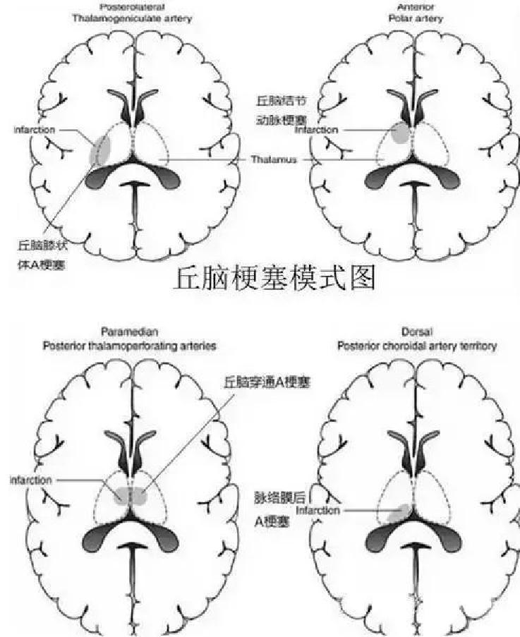 雙側丘腦梗死看完終生難忘