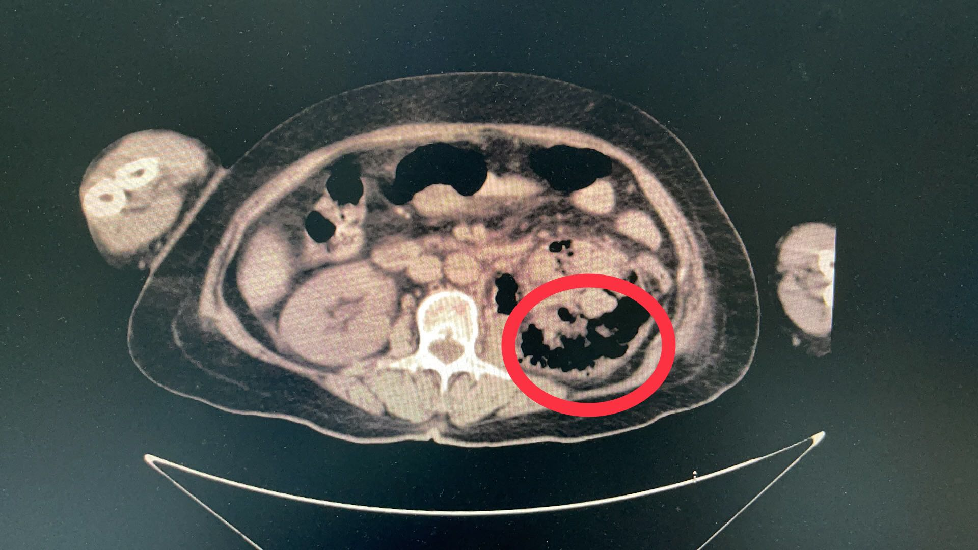 中国医大一院超声科介入团队为重症患者成功实施床旁肾脏穿刺置管引流