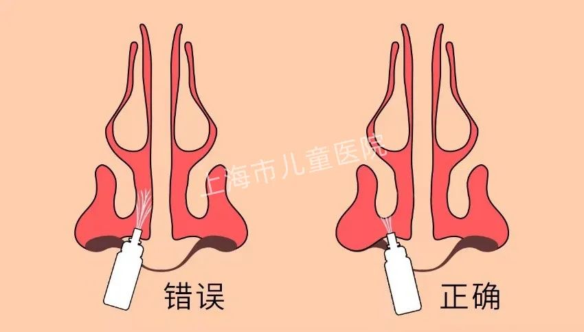 易過敏的春天呵護好兒童的鼻腔健康