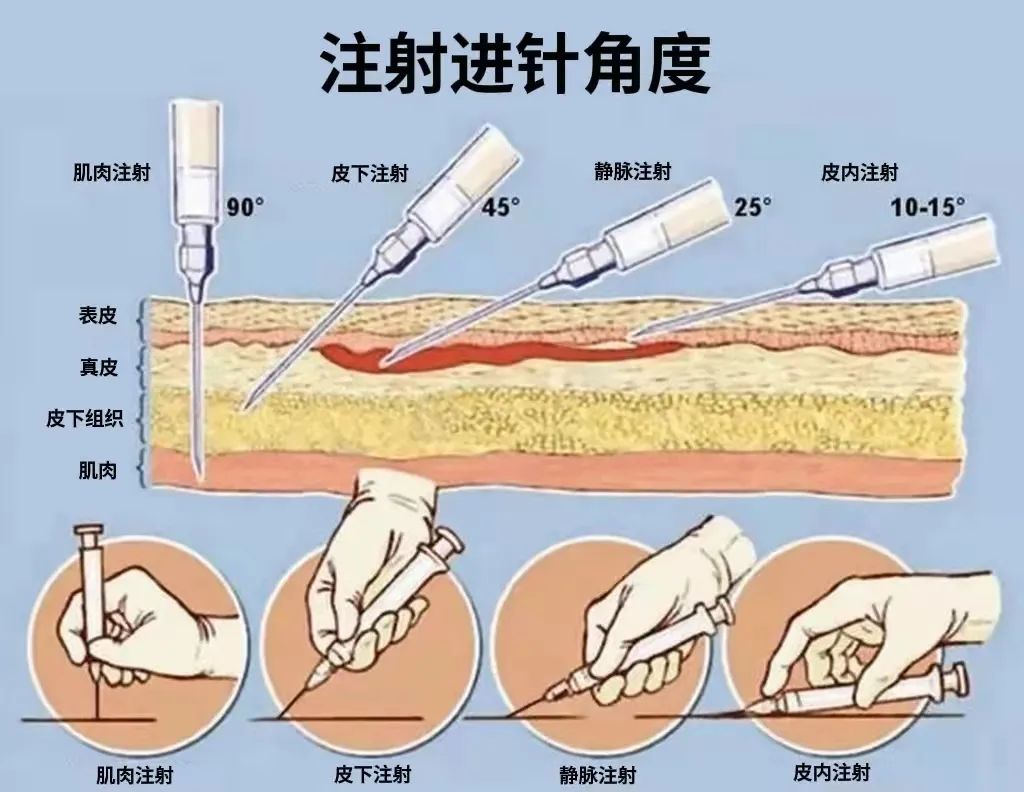 四大注射法进针角度图片