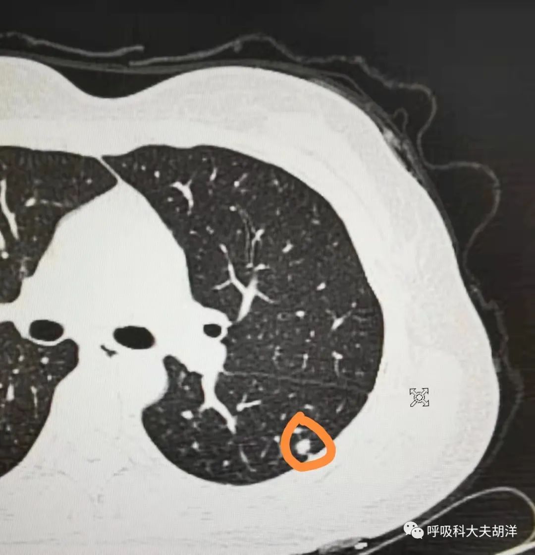 肺癌霍纳综合征图象图片