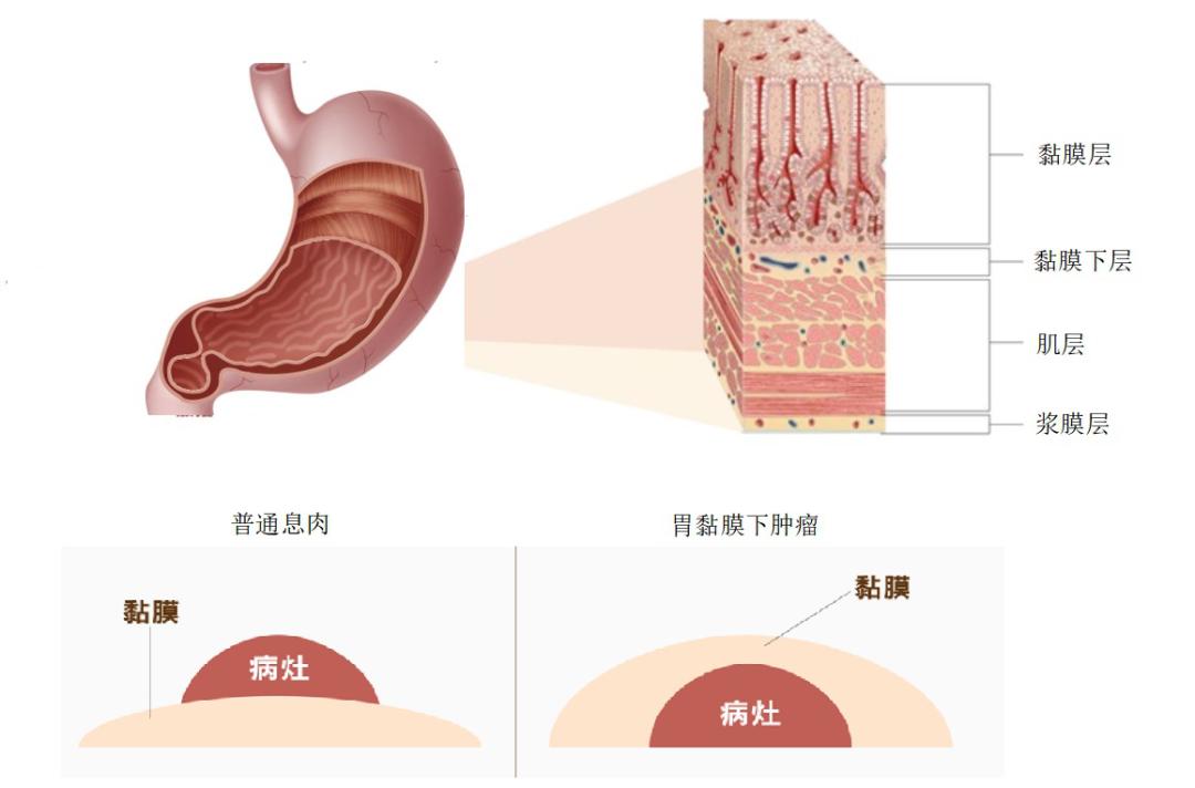 国际护胃日认识胃黏膜下肿瘤