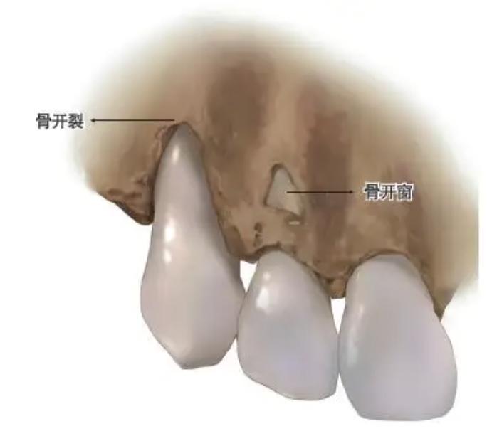 有人天生牙槽骨就比较壮比较结实,如果想后天努努力,也可以在运动和