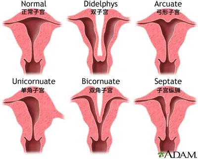 常见的子宫畸形图片图片
