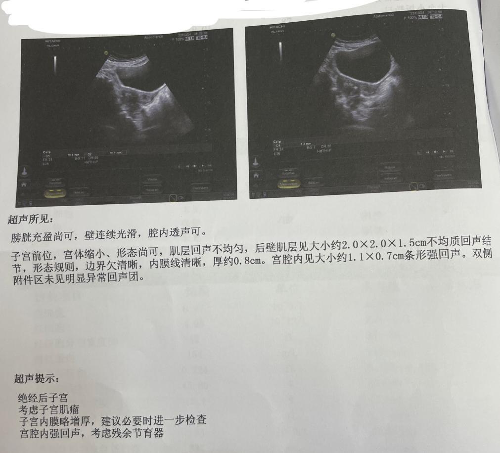 絕經後儘快取出節育器遲取的大多都後悔了