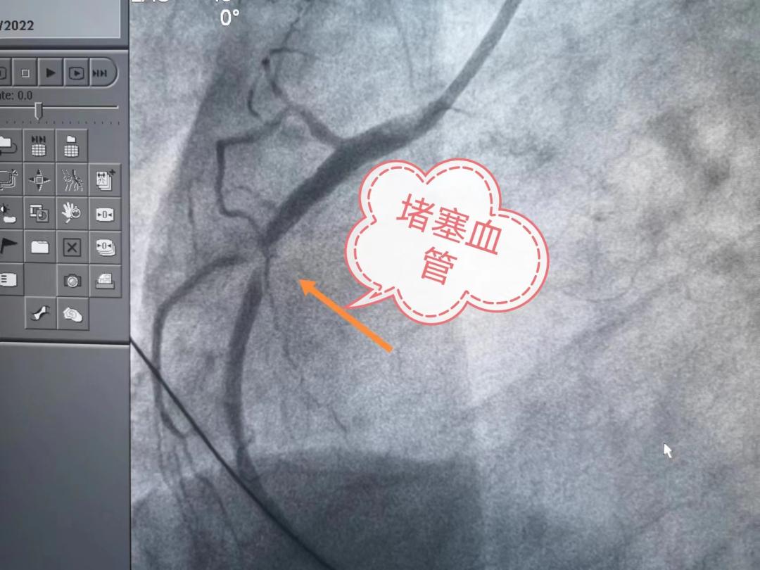 除颤后,送患者进入导管室,造影发现右侧血管近端99%狭窄,我们叫次全