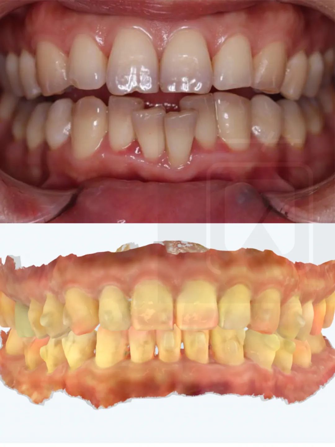 洗牙用牙线不会把牙缝弄大那牙缝咋越来越大