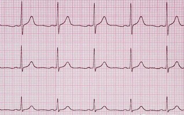 窦性心律心电图特点图片