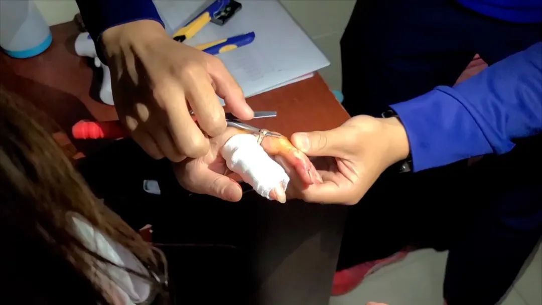 机器砸手难治疗求助消防来帮忙