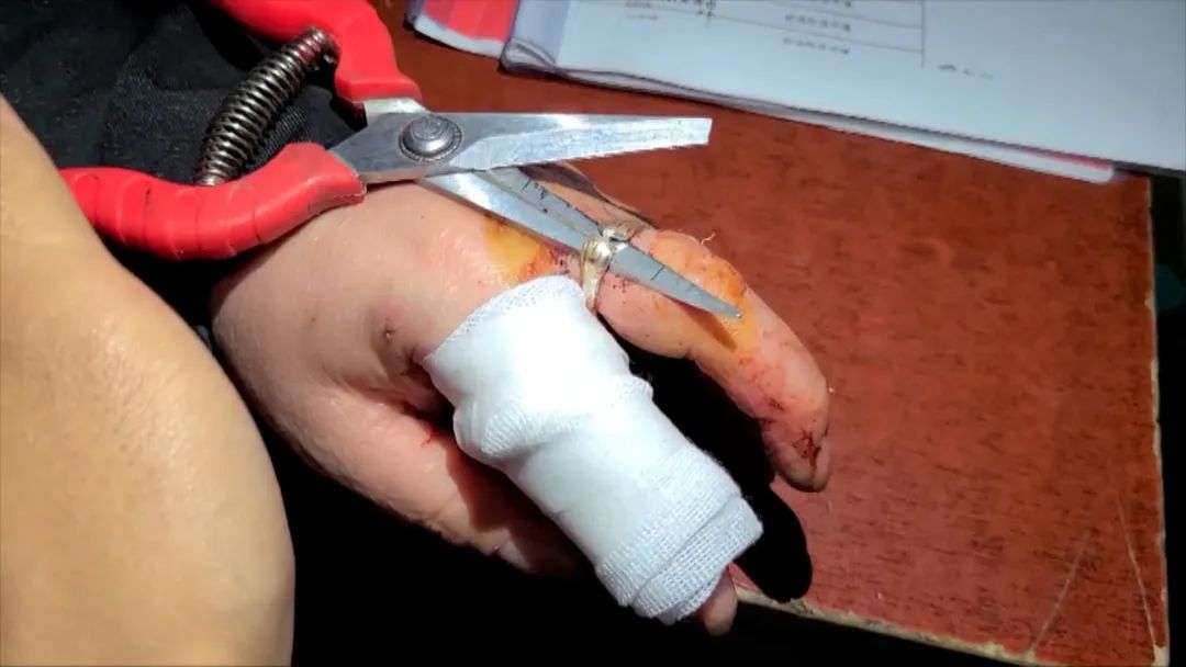 机器砸手难治疗求助消防来帮忙