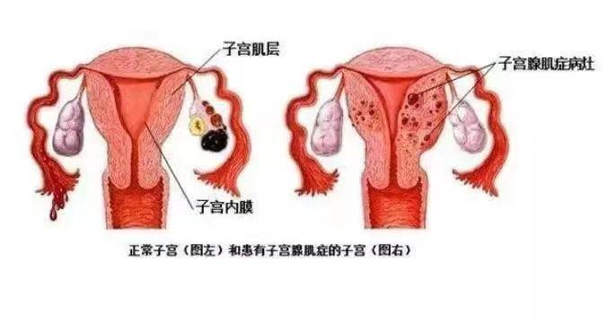 子宫腺肌症病灶图图片