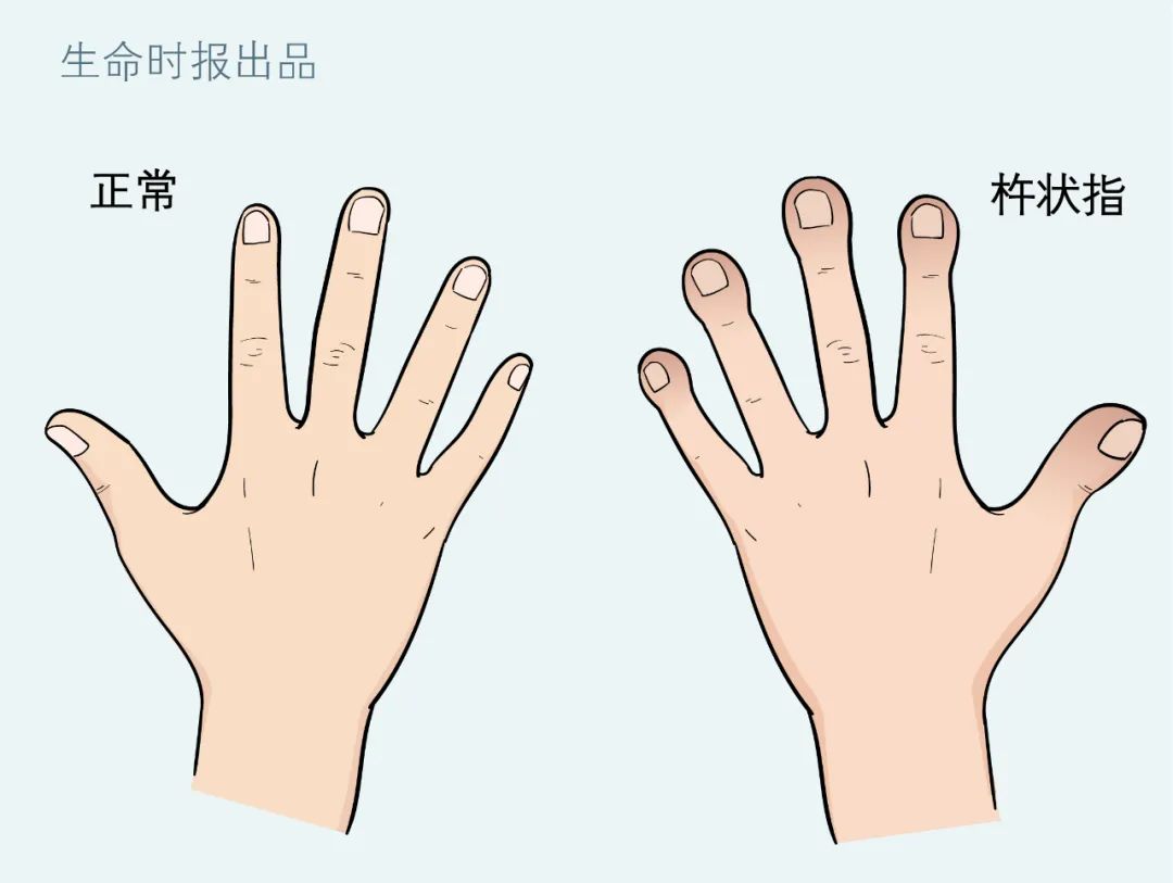 手指頭變粗一查竟是肺癌出現這些信號千萬別輕視