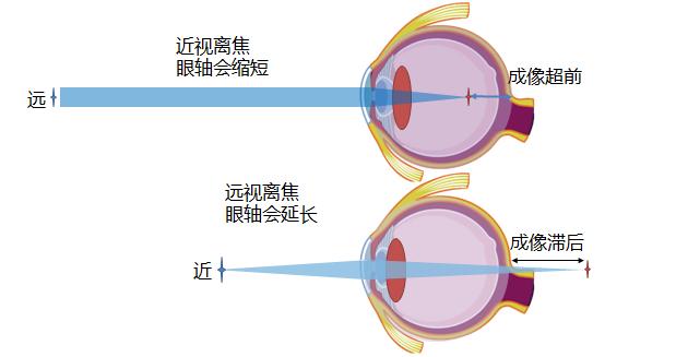 防控近视，先来弄清楚近视的原因