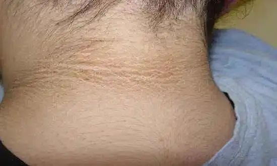 有人问,为什么会得多囊卵巢综合征?