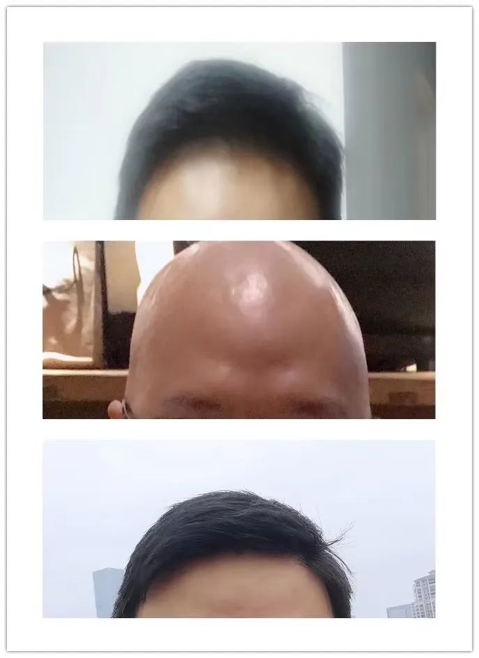 中间是卤蛋,后来头发又长出来了饮食和睡眠终于正常起来.