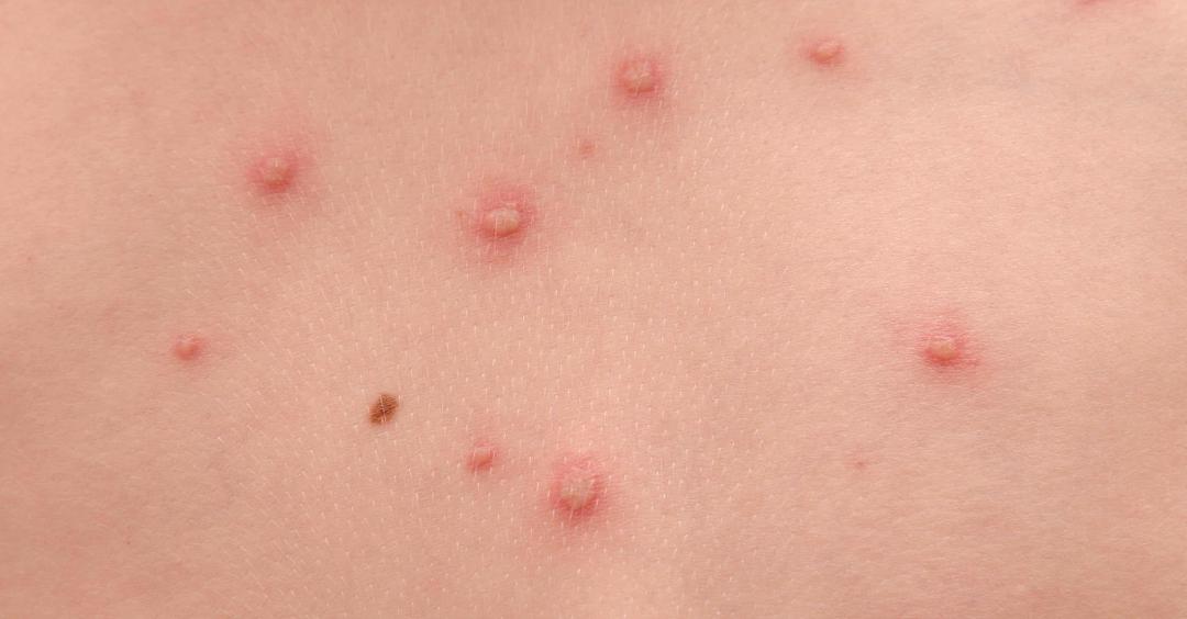 它会引起发热和广泛的特征性皮疹