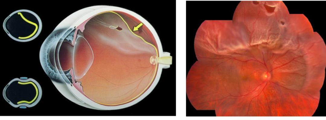它是由于周边视网膜发生变性,视网膜变薄产生裂孔,或者由于玻璃体后