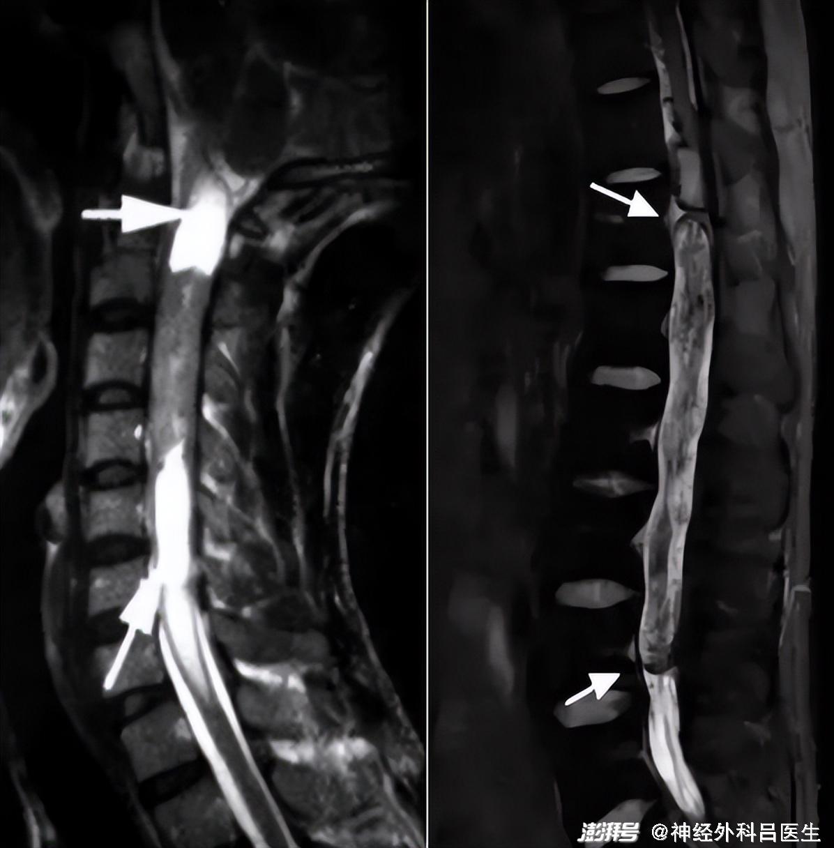 椎管内肿瘤科普系列四室管膜瘤手术能治愈的髓内肿瘤