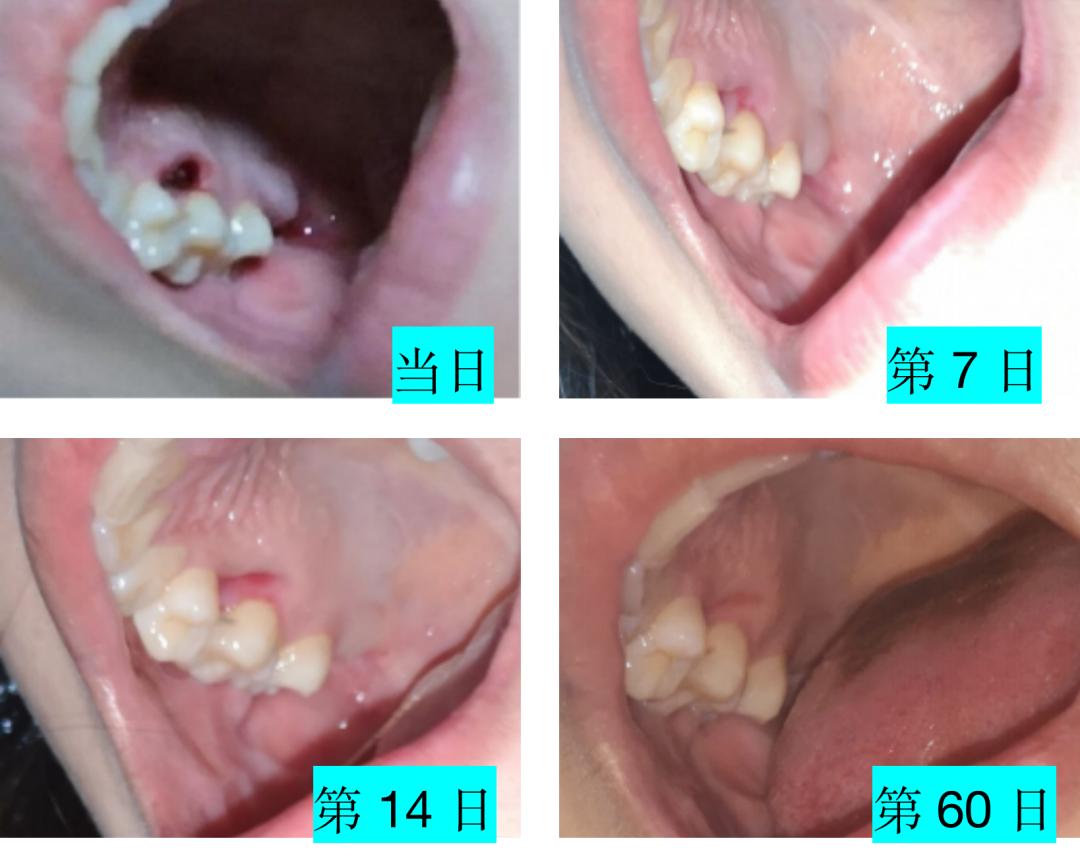战疫爱牙护齿99拔牙后的牙洞是怎么填满的