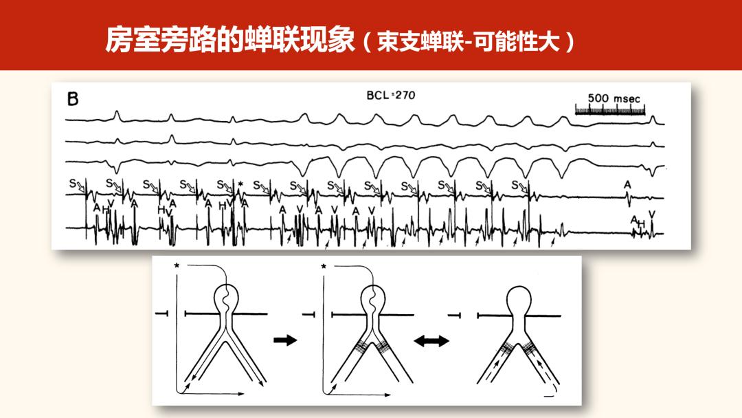 老生常談丨什麼是心律失常中的蟬聯現象