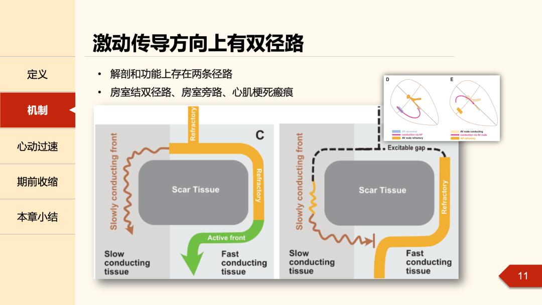 老生常谈丨什么是心律失常中的折返现象