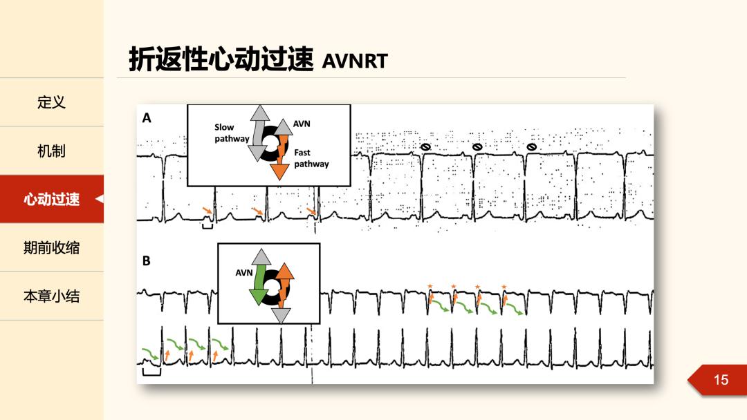 老生常谈丨什么是心律失常中的折返现象