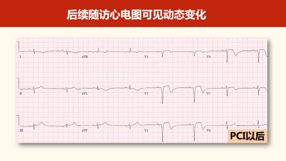 胸导联波形图片