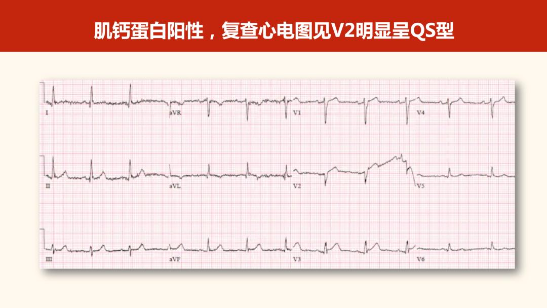 胸导联波形图片