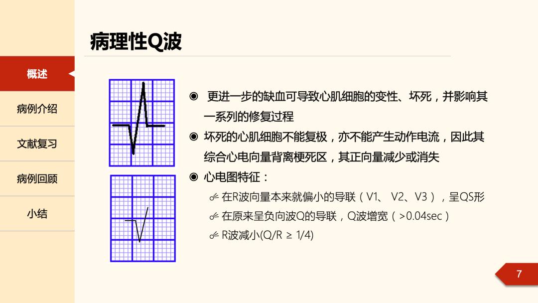 心电图q波正常值图片