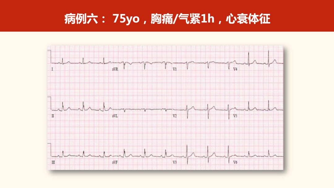 心电图q波正常值图片