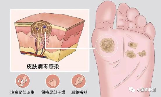 尋常疣怎麼治療