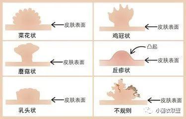 尋常疣怎麼治療