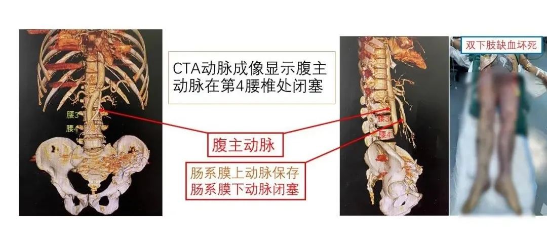 组织第一次全院多学科会诊讨论后决定先行双侧髋关节离断试图保住骨盆