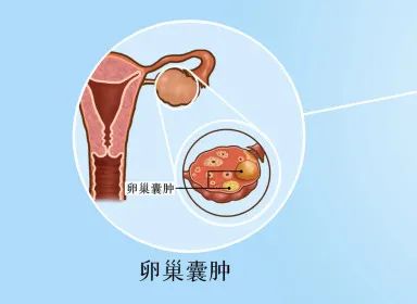 输卵管副中肾管囊肿图片
