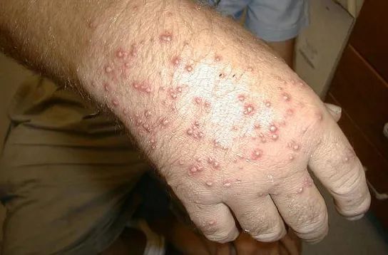 带娃去户外当心6类毒虫尤其第一种严重可致命