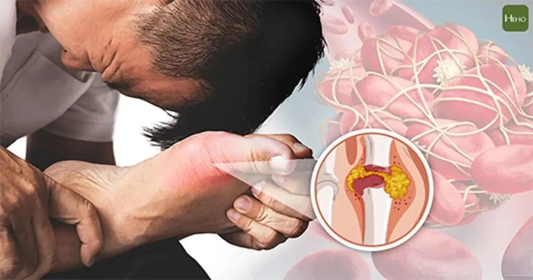 痛风发作怎么办