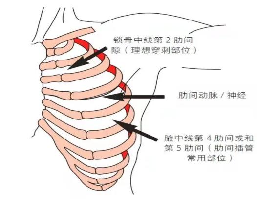 气胸穿刺部位示意图图片