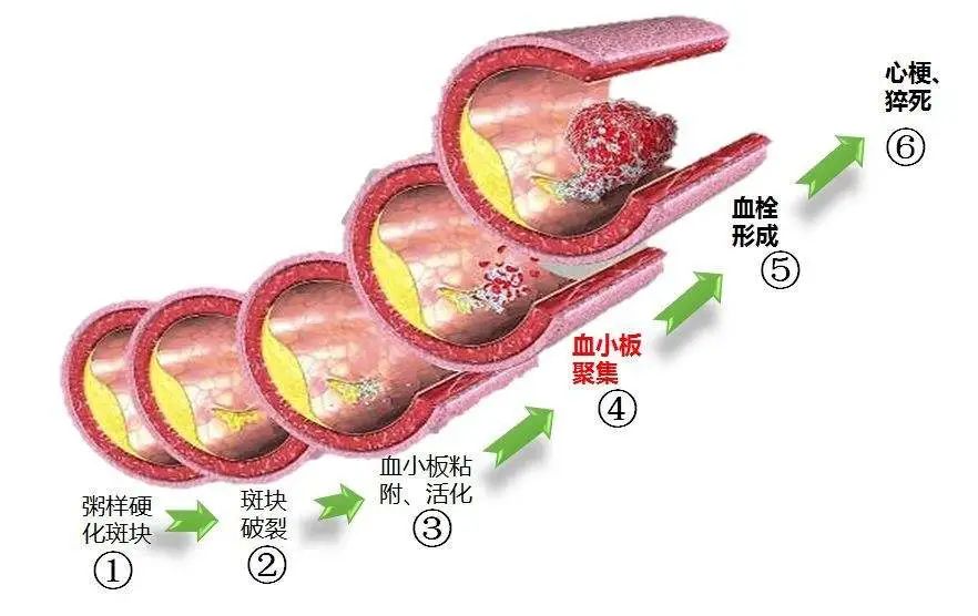 抗血小板药物影响手术麻醉吗
