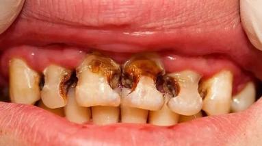 牙,全都是黑色的蛀牙,而且只要用镊子一捏,牙齿就会像饼干一样碎掉