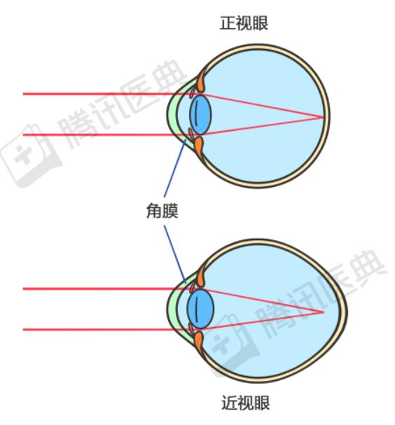 眼睛近视分析图图片