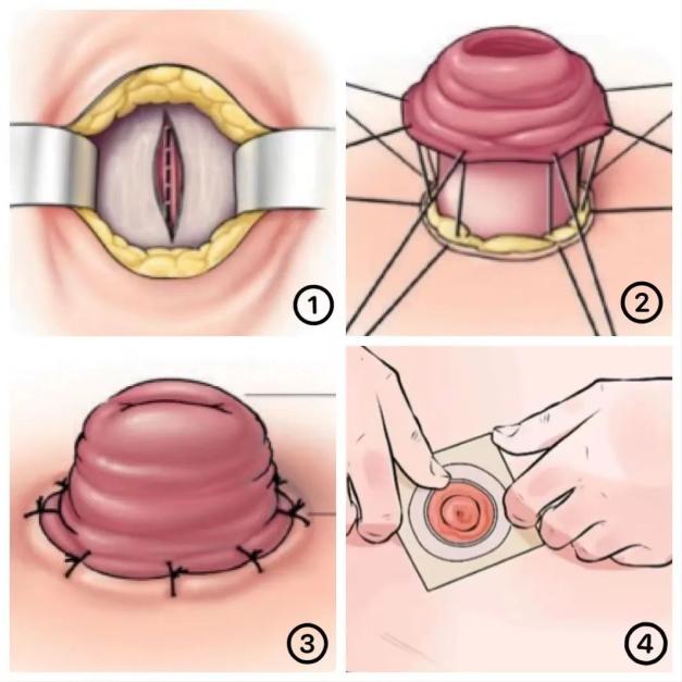 造口手术过程图片