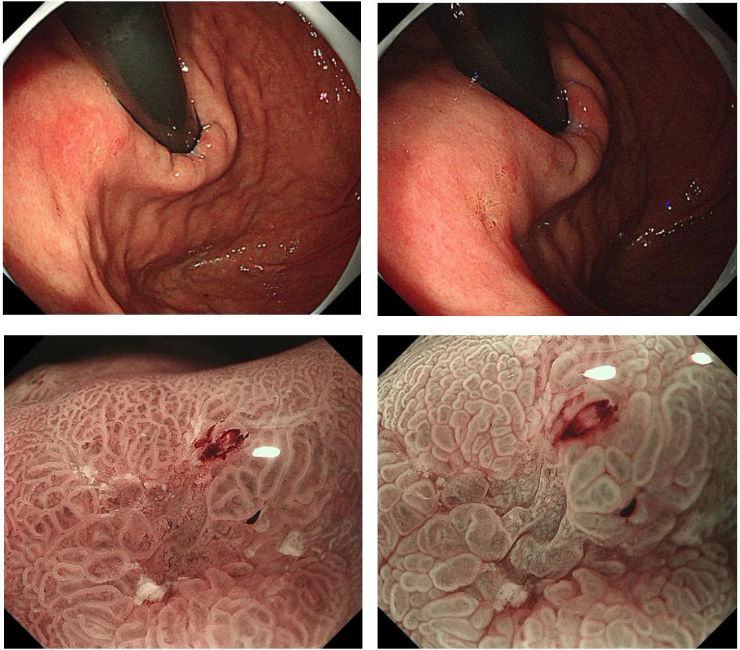 为什么需要内镜精查