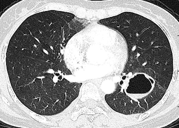 空洞气液平居然裂开了病因居然是