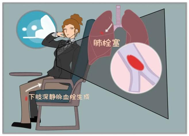 同心战疫疫情之下的久坐危机深静脉血栓