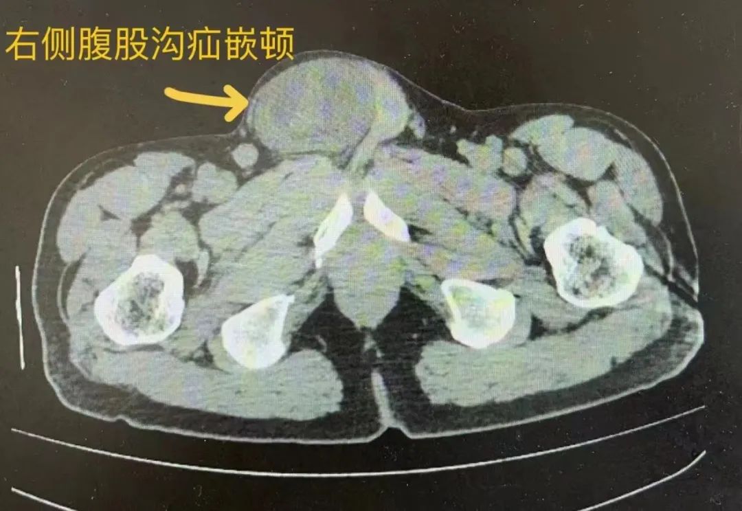 腹股沟疝气ct图片图片