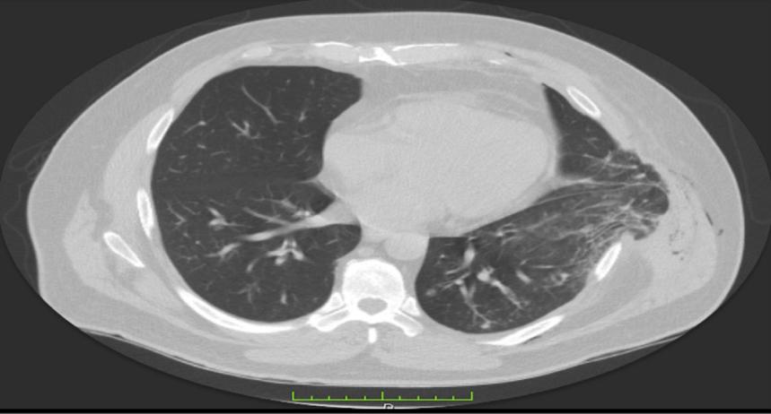 慢阻肺出現急性胸痛看完胸部ct我驚呆了