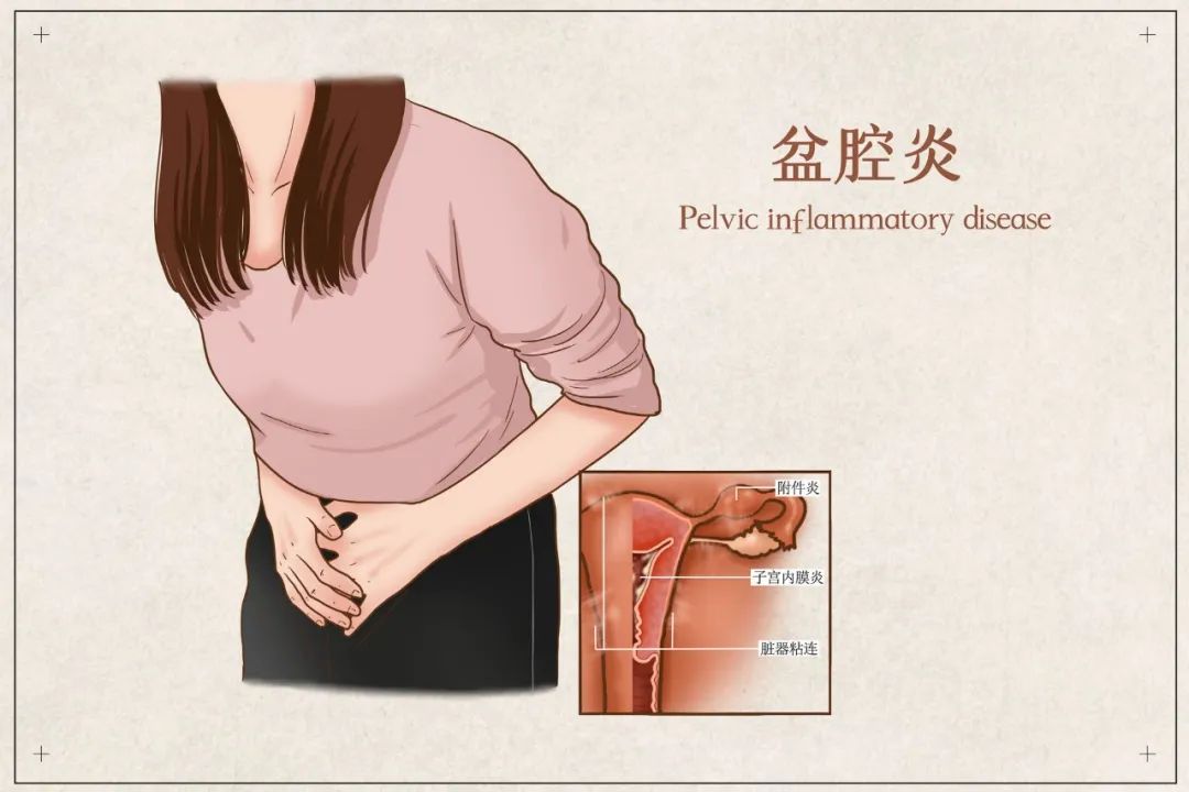 宫外孕疼痛位置图片