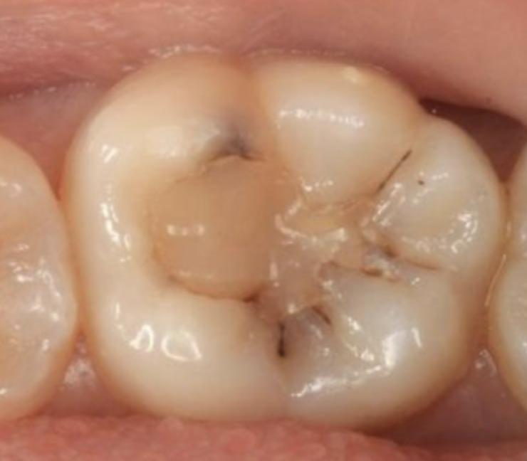 补牙过几年后材料会老化会继发龋为什么还要补牙