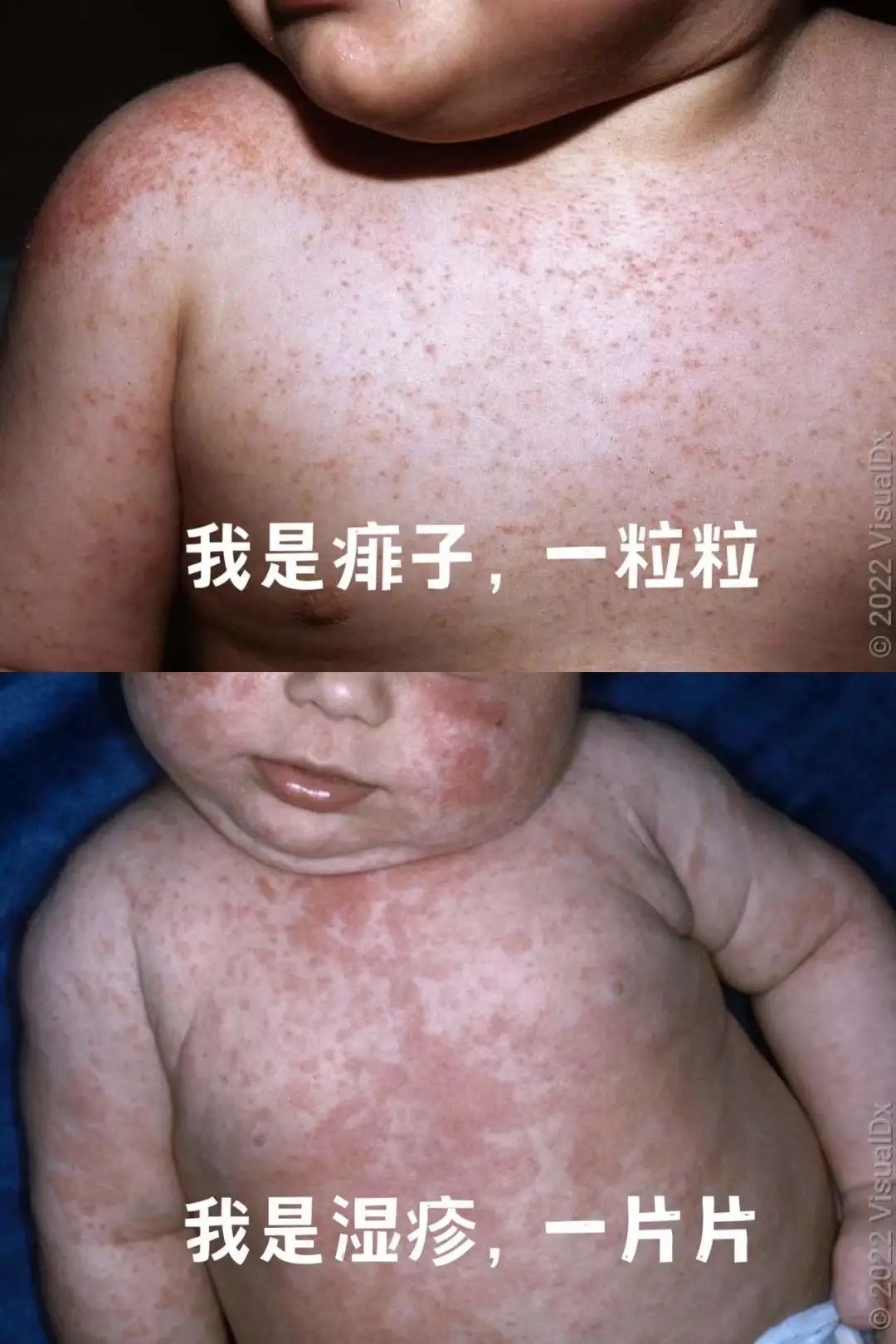湿疹和热疹图片区分,大人湿疹图片,大人热疹症状图片(第6页)_大山谷图库