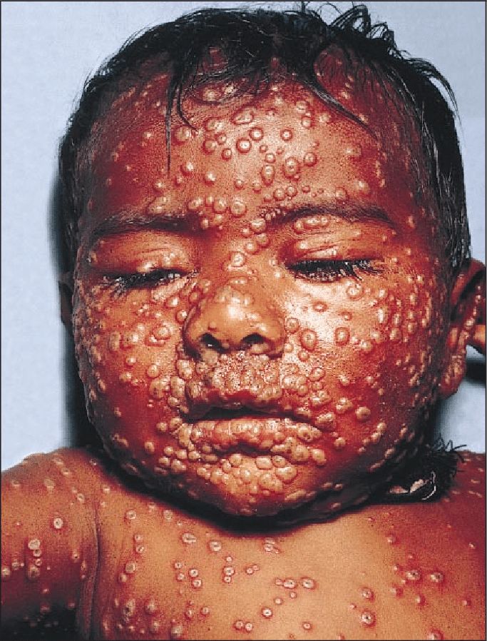 天花患儿的特征性面部和躯干皮疹天花感染的并发症包括皮肤继发细菌